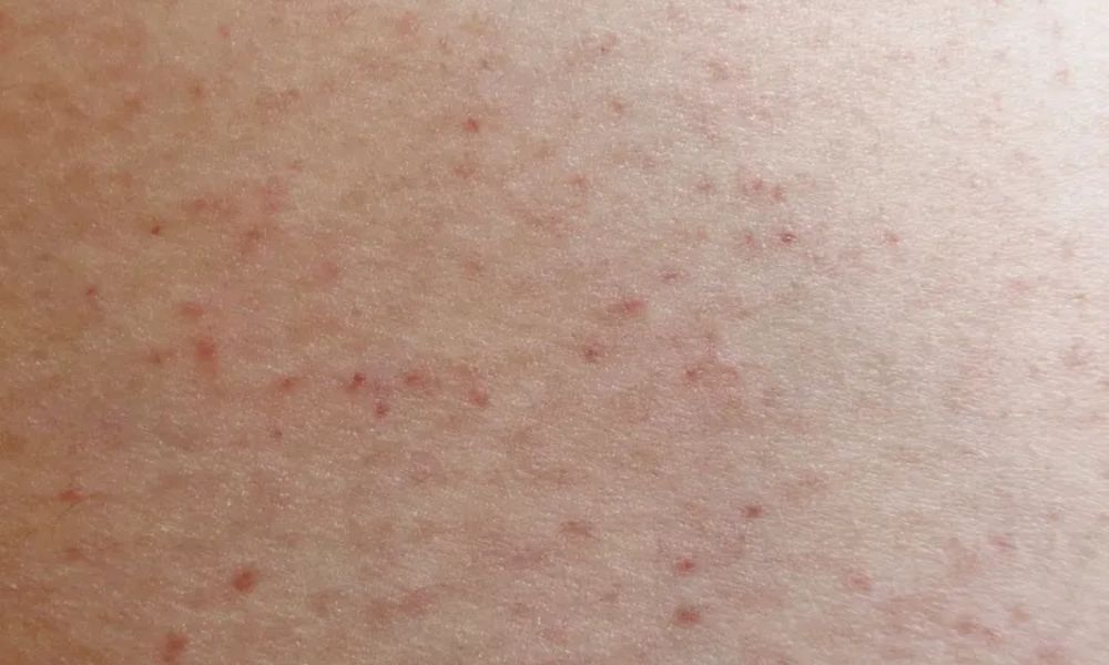 Popoda neden sivilce çıkar